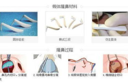 膨体假体隆鼻,材料特性、优势与风险全面解析